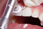 отзывы пациентов о профессиональной чистке зубов