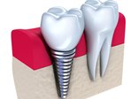 дентальная имплантация зубов